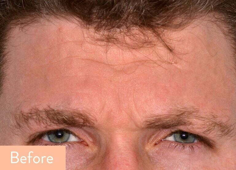 forehead anti-wrinkle treatments
