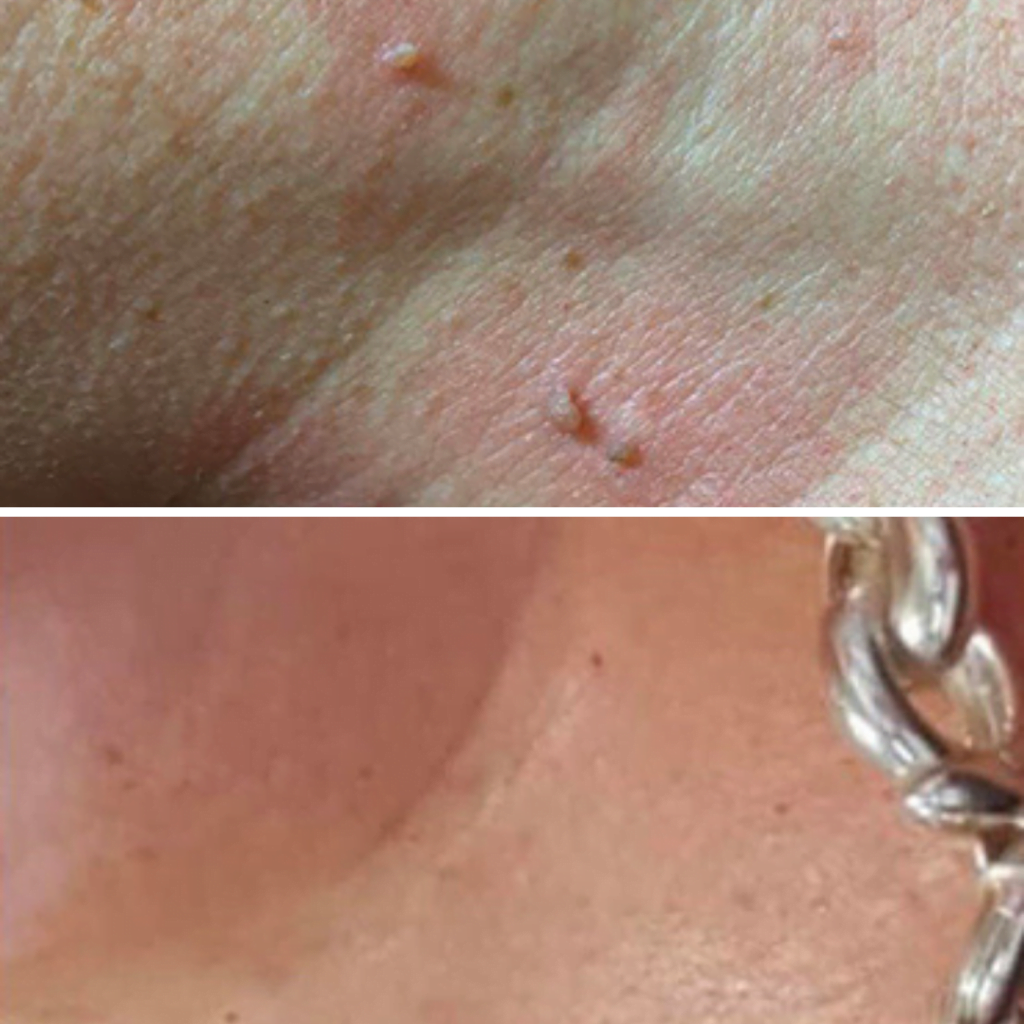 before and after cryopen treatment